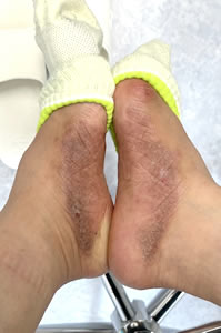 治療開始から約1か月後